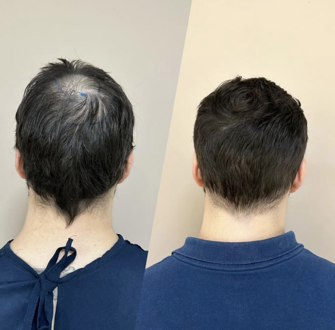 Resultado de Reconstrução da coroa — antes e depois