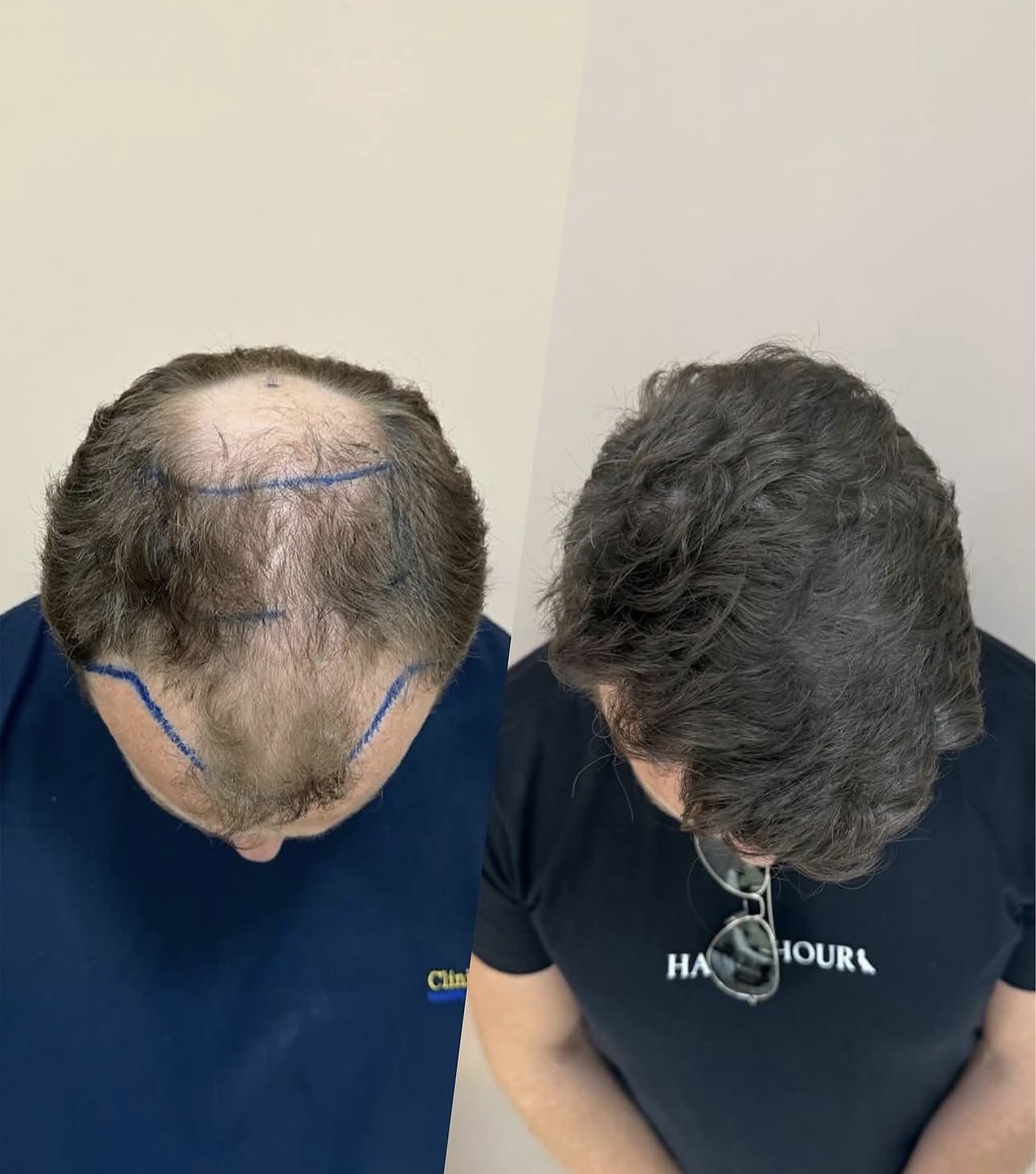 Resultado de Densidade — antes e depois