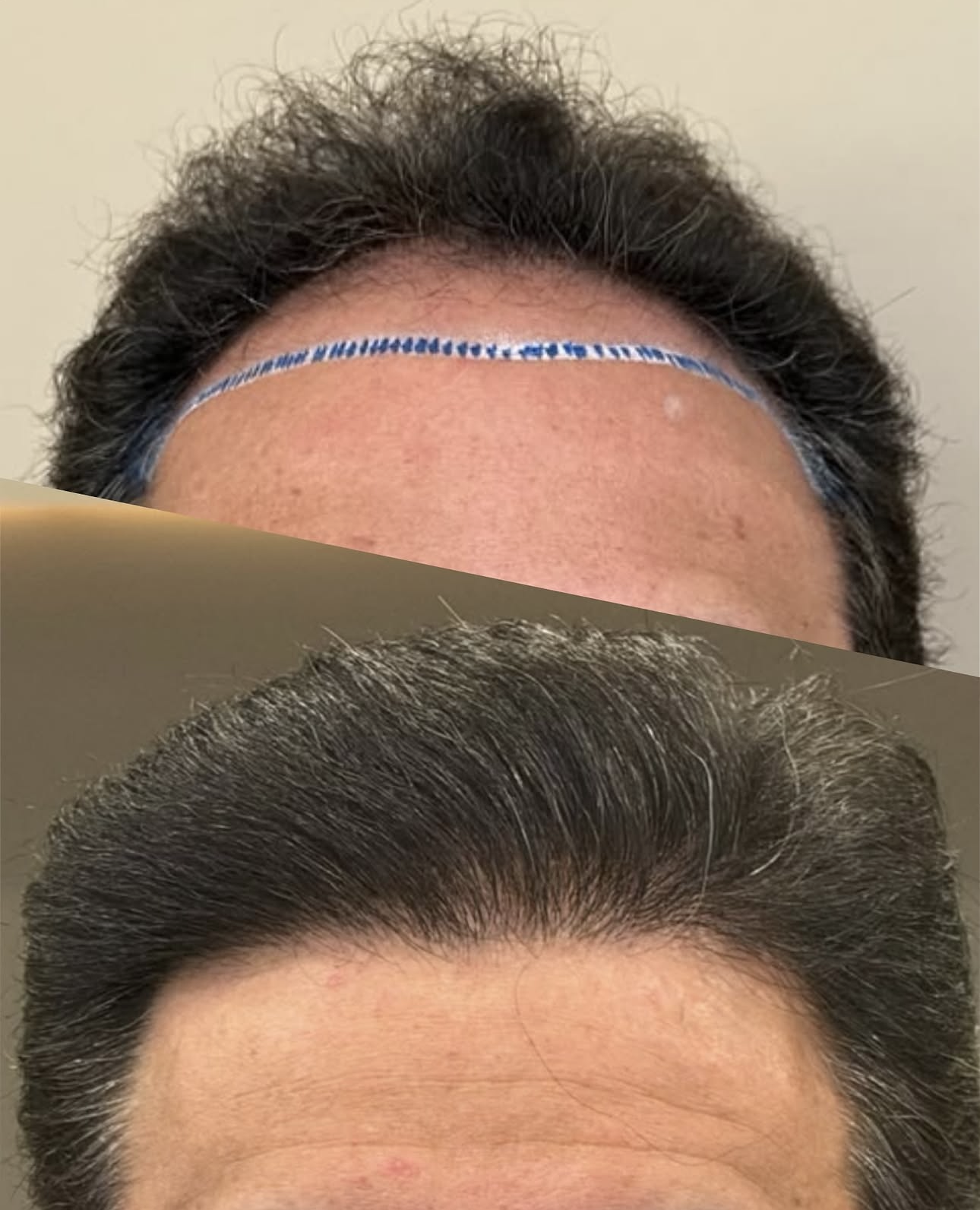 Resultado de Linha frontal — antes e depois